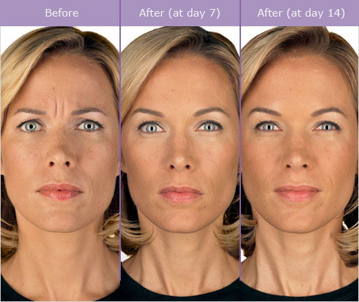 Botox Archives Evolvmd