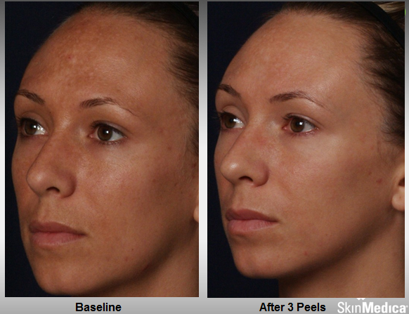 Chemical Peels Evolvmd Laser Tattoo Removal Microdermabrasion Botox In Milwaukee Wi