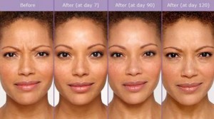 Laser Skin Resurfacing Wauwatosa EvolvMD