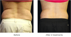 Vanquish offers no surgery, no downtime in Milwaukee, WI, at EvolvMD