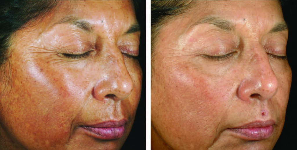 Before and after of Skin Medica chemical peel in Milwaukee, WI at Medspa