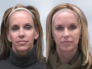 sculptra-before-and-after