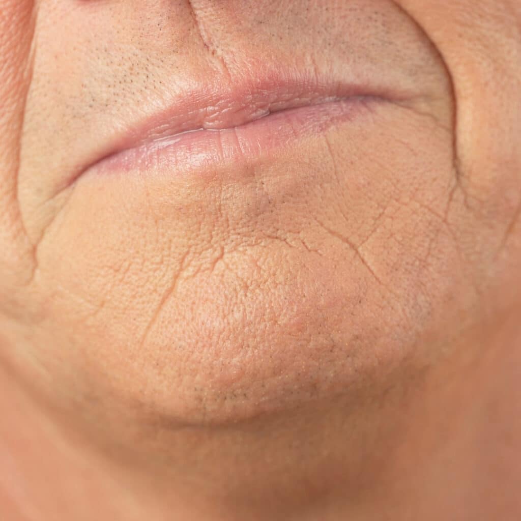 A person showing Chin Wrinkles​ with Restylane Silk