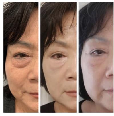 Skin treatment results of Agnes Radiofrequency Microneedling