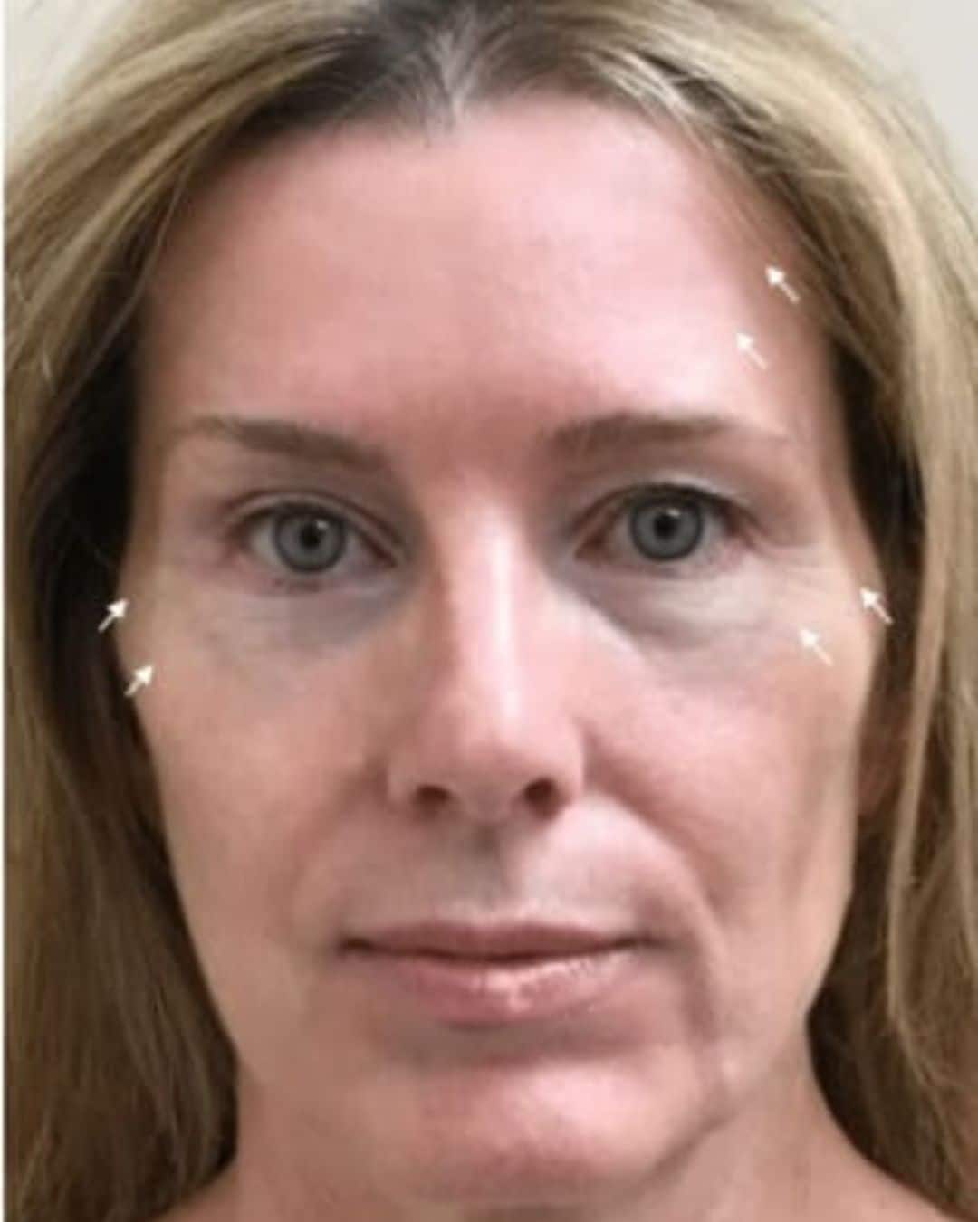 After Sylfirm X Microneedling