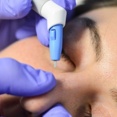 Agnes RF Miscroneedling for Eye bags and double chin near me milwaukee