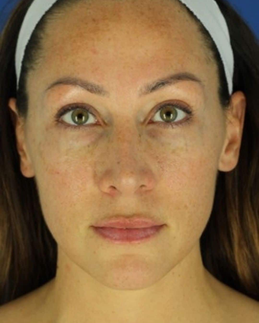 Before Sylfirm X Microneedling