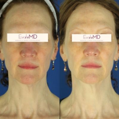 Before and after Sylfirm near me