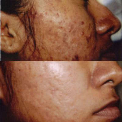 Before and after chemical peel near me