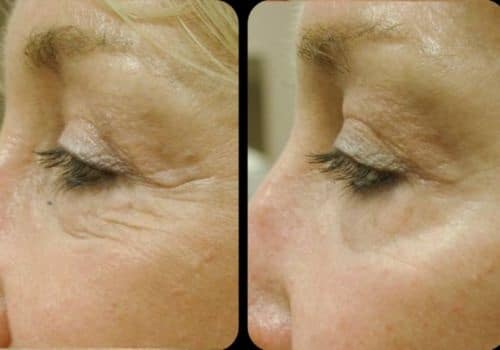 Before and after results of SmartSkin CO2 laser treatment for wrinkles and fine lines at EvolvMD Milwaukee