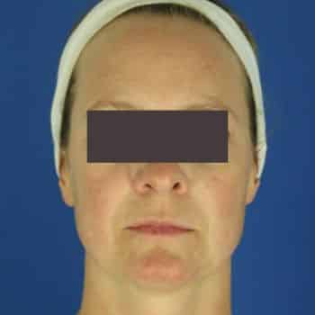 Before Dysport to Smooth Forehead Wrinkles 