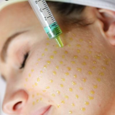 BioRePeel Chemical Peel No Downtime Peel near me Milwaukee Wi