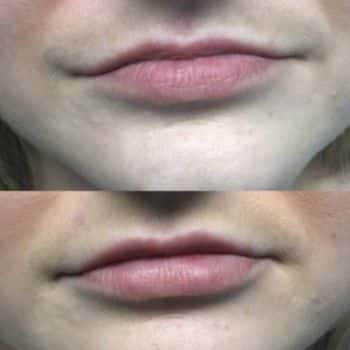 Botox lip flip for fuller upper lips at EvolvMD MedSpa