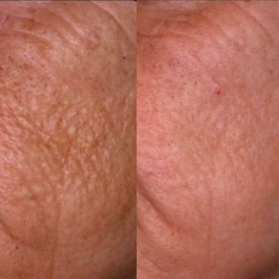 milwaukee co2 laser treatment skin rejunveation