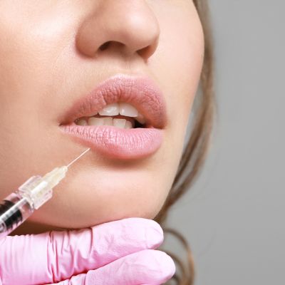 Close-up image of naturally plump, defined lips after Restylane Kysse lip filler treatment