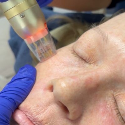 Sylfirm Rf near me EvolvMD Milwaukee