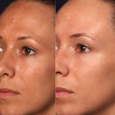 Get rid of acne scarring near me