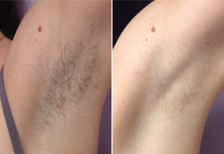 Qswitched Underarms Whitening Laser Treatment