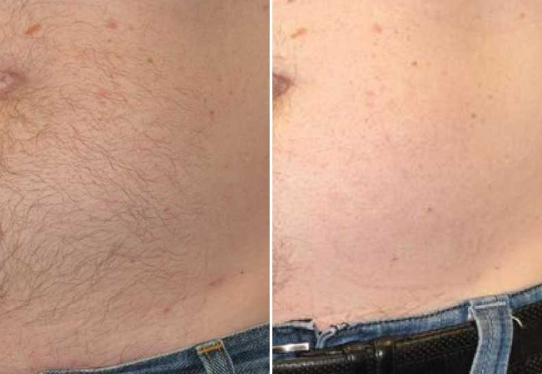 Laser Hair Removal at EvolvMD Milwaukee, WI. Laser Hair Removal before and after photo. Laser Hair Removal near me.