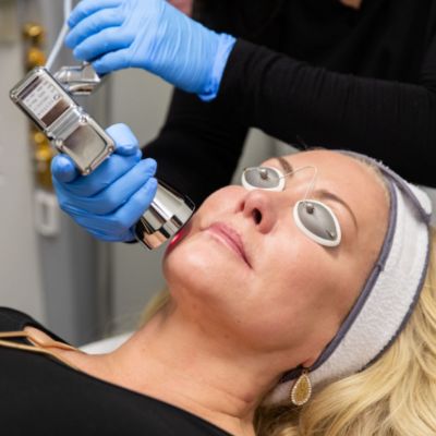 Microlaser peel milwaukee wi med spa