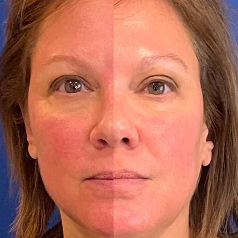 post- laser cryo treatment for refness wauwatosa