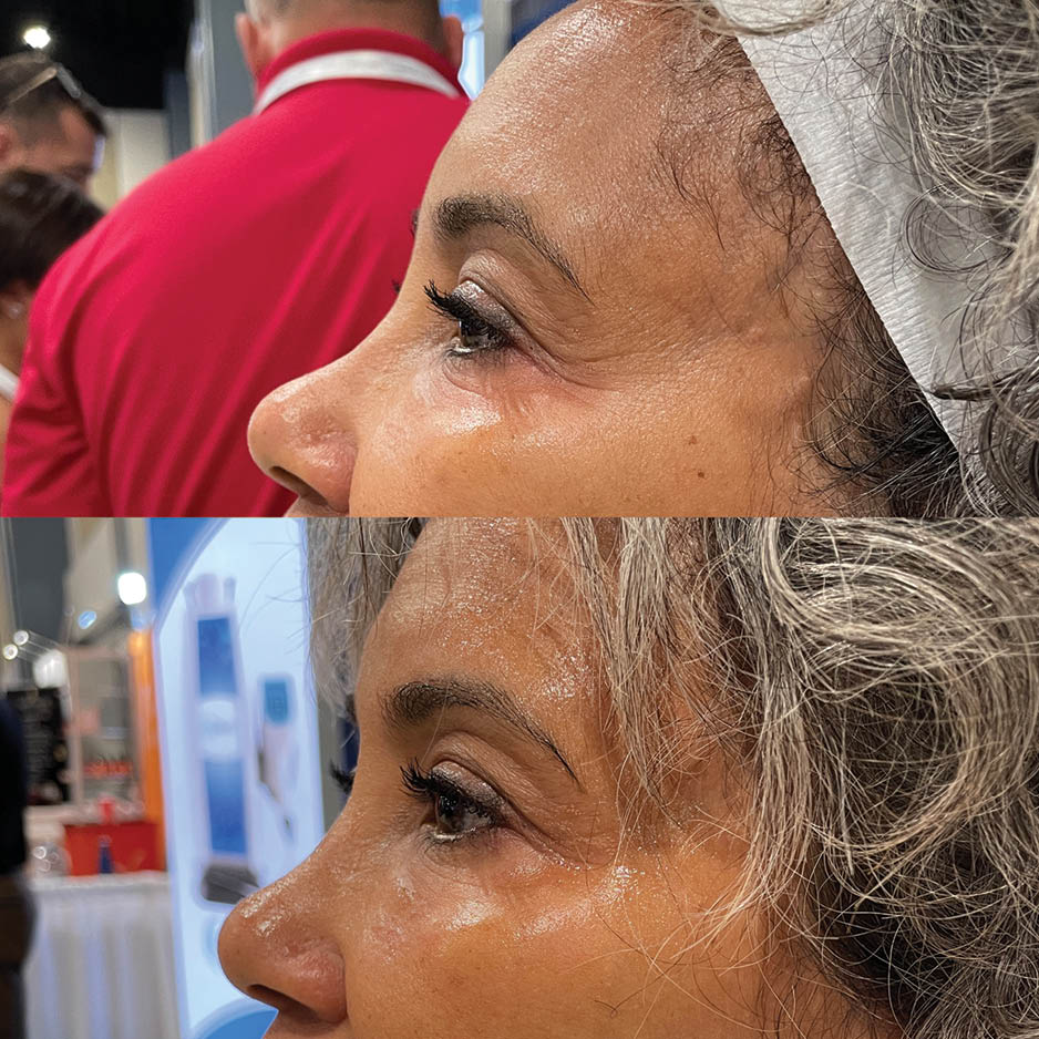 cryo therapy post laser treatment