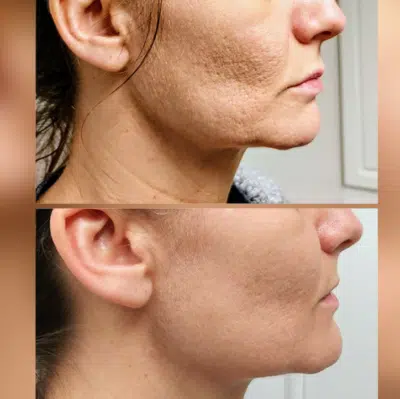 Scarlet Radiofrequency Microneedling Before and After at EvolvMD Medspa Milwaukee Wi