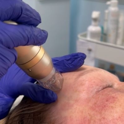 Sylfirm Skin Tightening Milwaukee WI EvolvMD Medical Spa
