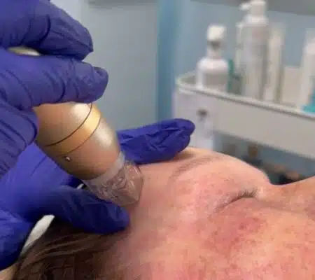 Skin Tightening Treatment Milwaukee