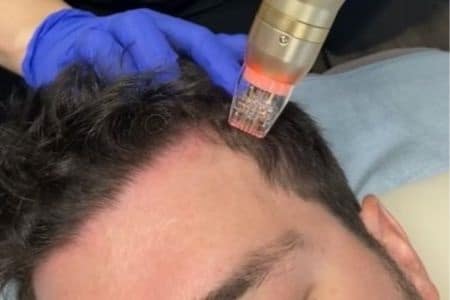 Sylfirm for Hair Loss versus PRP Microneedling Milwaukee WI EvolvMD Medi Spa