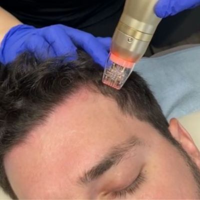 RF microneedling to treat hair loss and hair thinning med spa milwaukee