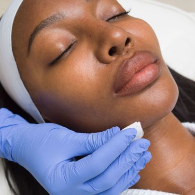 Vi Peel for darker skin tones near me