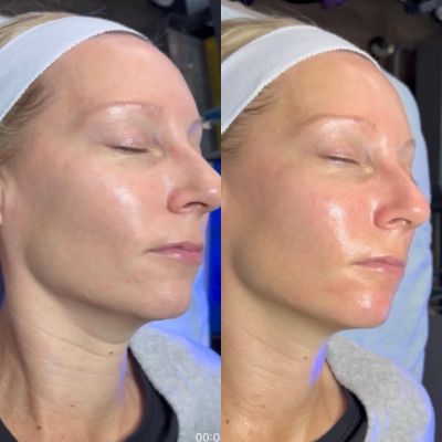 Woman with glowing skin before and after a hydrafacial at EvolvMD med spa milwaukee