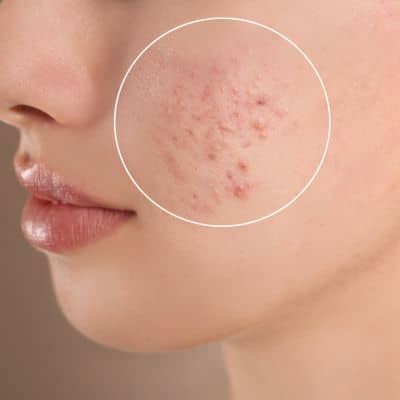 Close up of a person's face with a circle around her acne