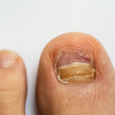aerolase to treat toe fungus near me milwaukee