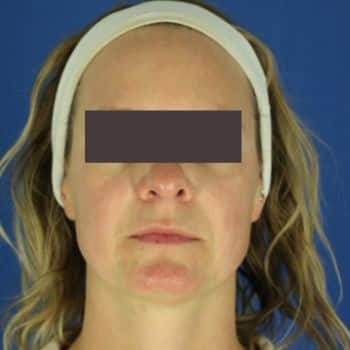 After Dysport to Smooth Forehead Wrinkles 
