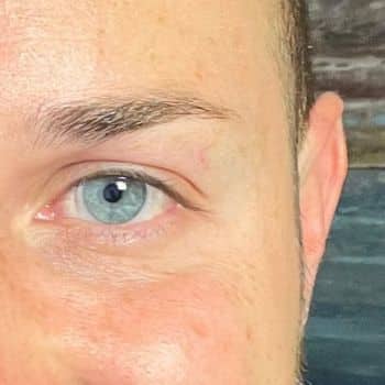 After Sylfirm X Microneedling