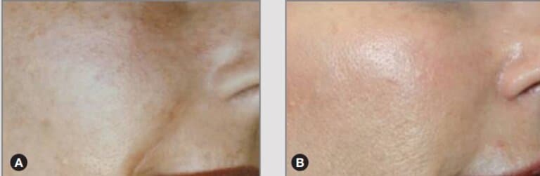 Before & After Forever Young BBL Photofacial - Cheek