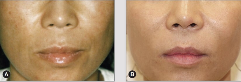 Before & After Forever Young BBL Photofacial - Fae