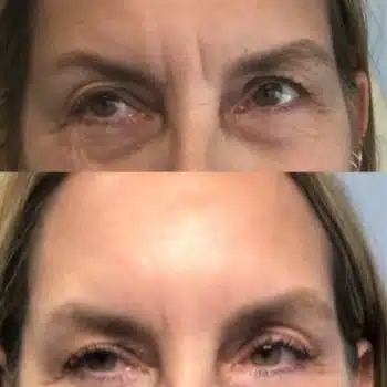before and after Botox to treat 11s mad lines near me milwaukee botox near me