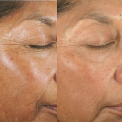 milwaukee chemical peel near me med spa milwaukee