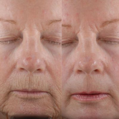 before and after co2 laser treatment milwaukee