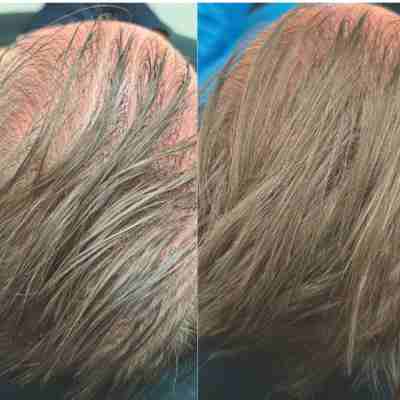 before and after hair rejuvenation at milwaukee med spa