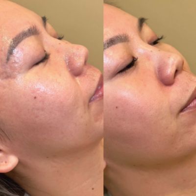 before and after toskani mesoneedling acne treatment milwaukee evolvmd medspa and wellness