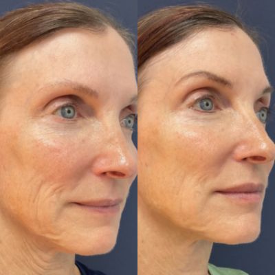 before and after toskani mesoneedling for reverse aging milwaukee evolvmd medspa and wellness (1)