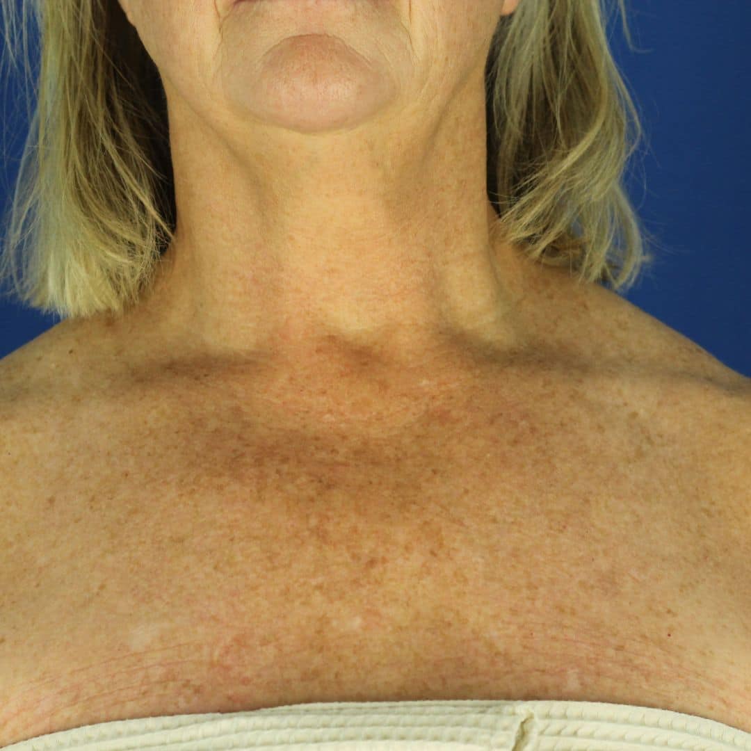 chemical peel for neck and chest