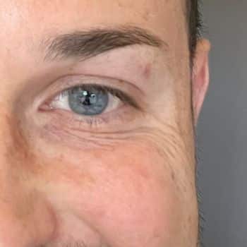 Before Sylfirm X Microneedling