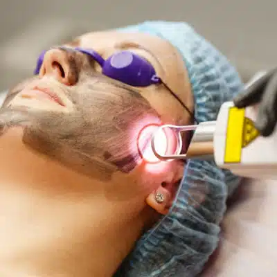 A person getting a carbon laser facial treatment