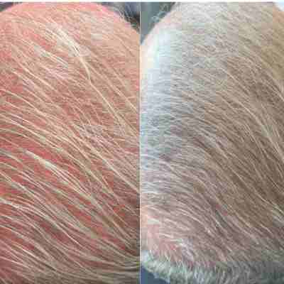 cryo hair before and after