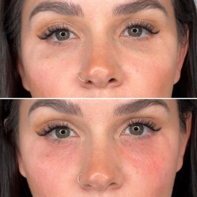 Mermaid Facial with Salmon PDRN at I EvolvMD Milwaukee